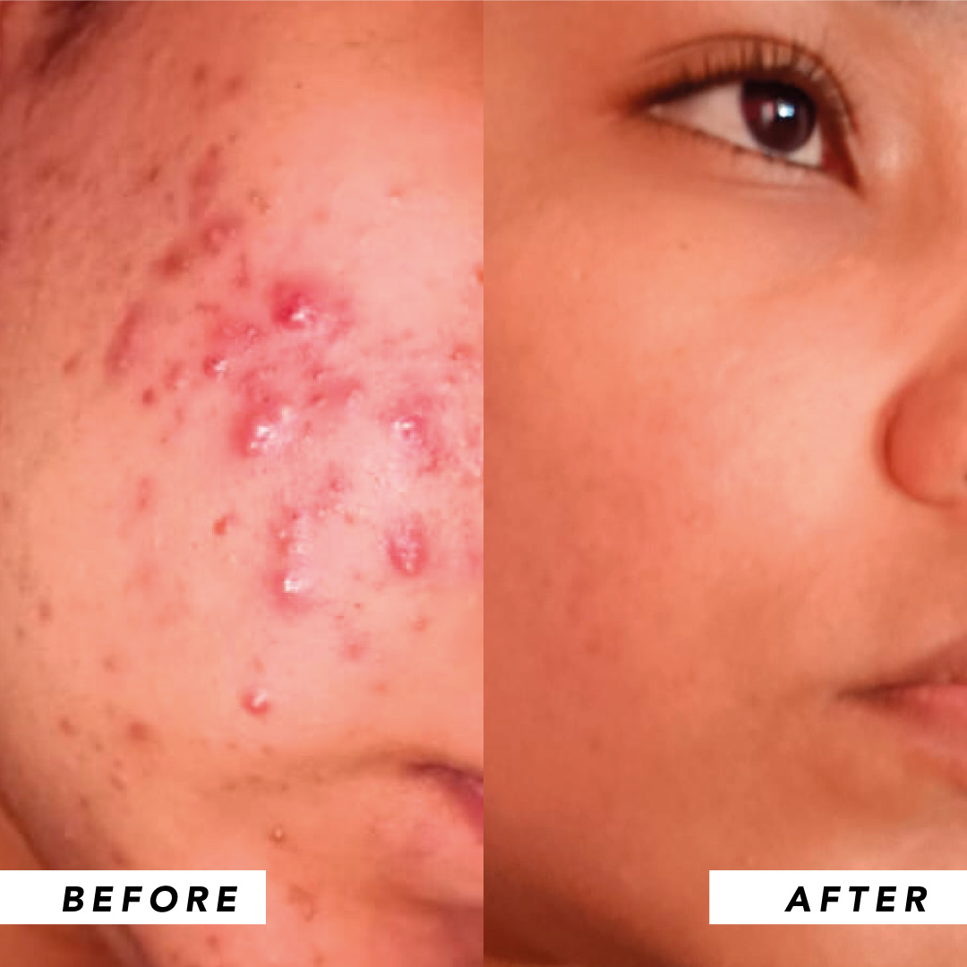 Infinitek Paris woman's testimony: real changes in acne, wrinkles, dark circles, skin, face, facial care