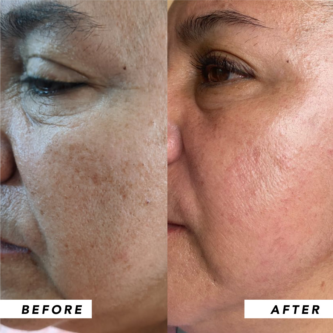 Infinitek Paris woman's testimony: real changes in acne, wrinkles, dark circles, skin, face, facial care