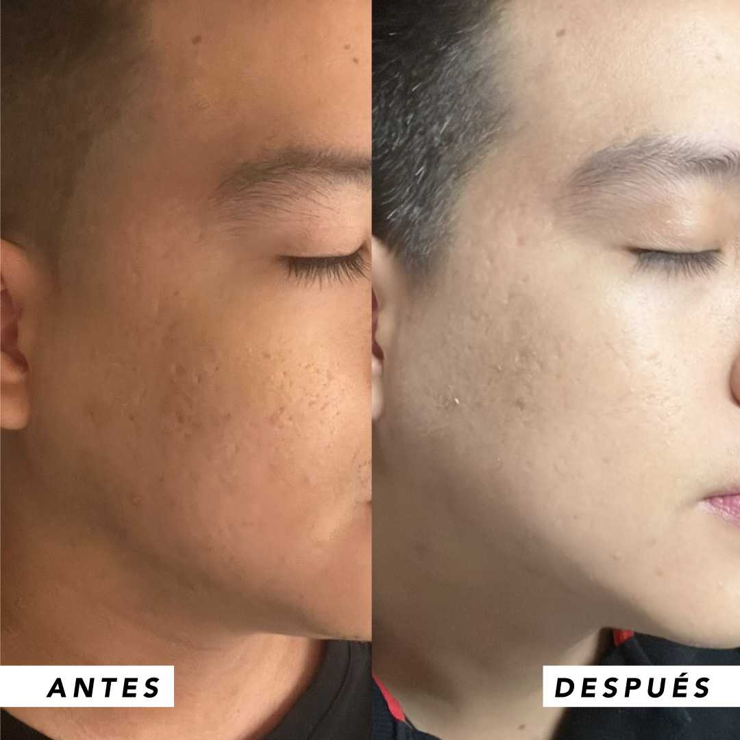 testimonio mujer infinitek paris, cambios reales en acne, arrugas, ojeras, piel, rostro, cuidado facial